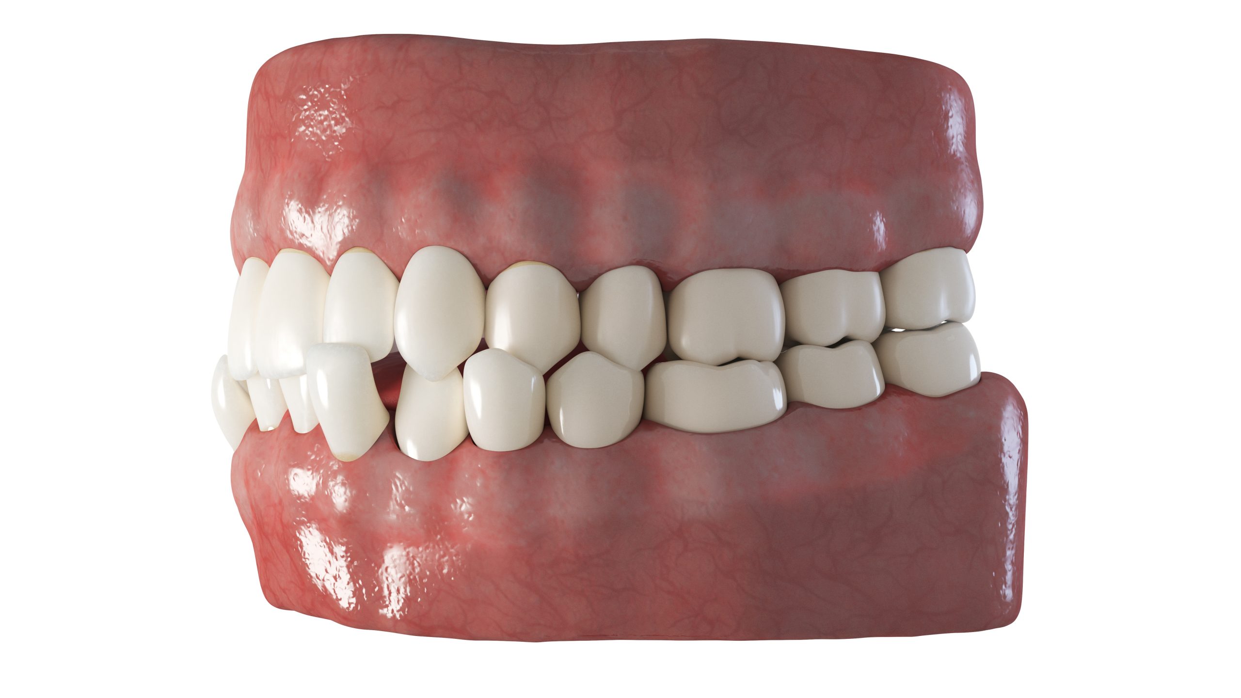 example of crossbite teeth