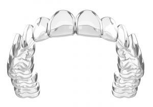 example of invisible braces for adults