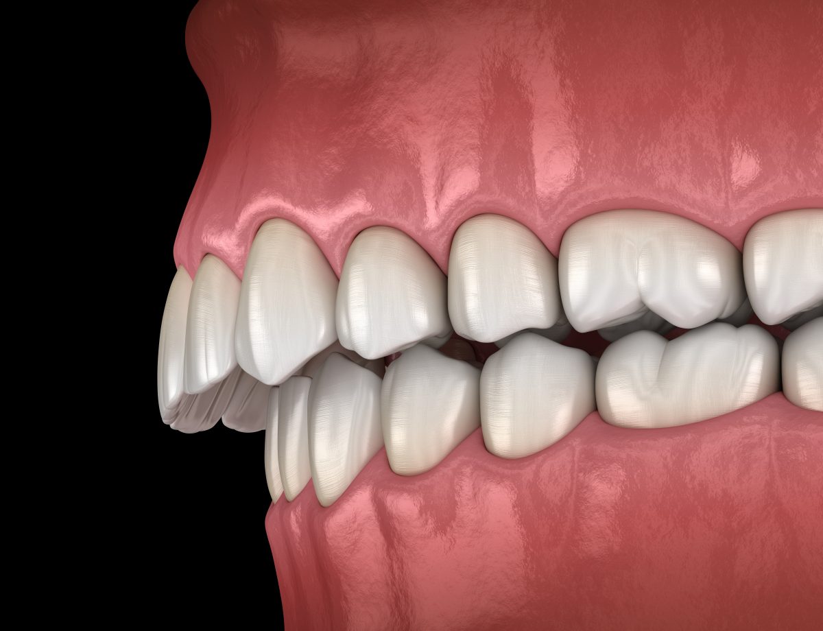 rendering of extreme overbite