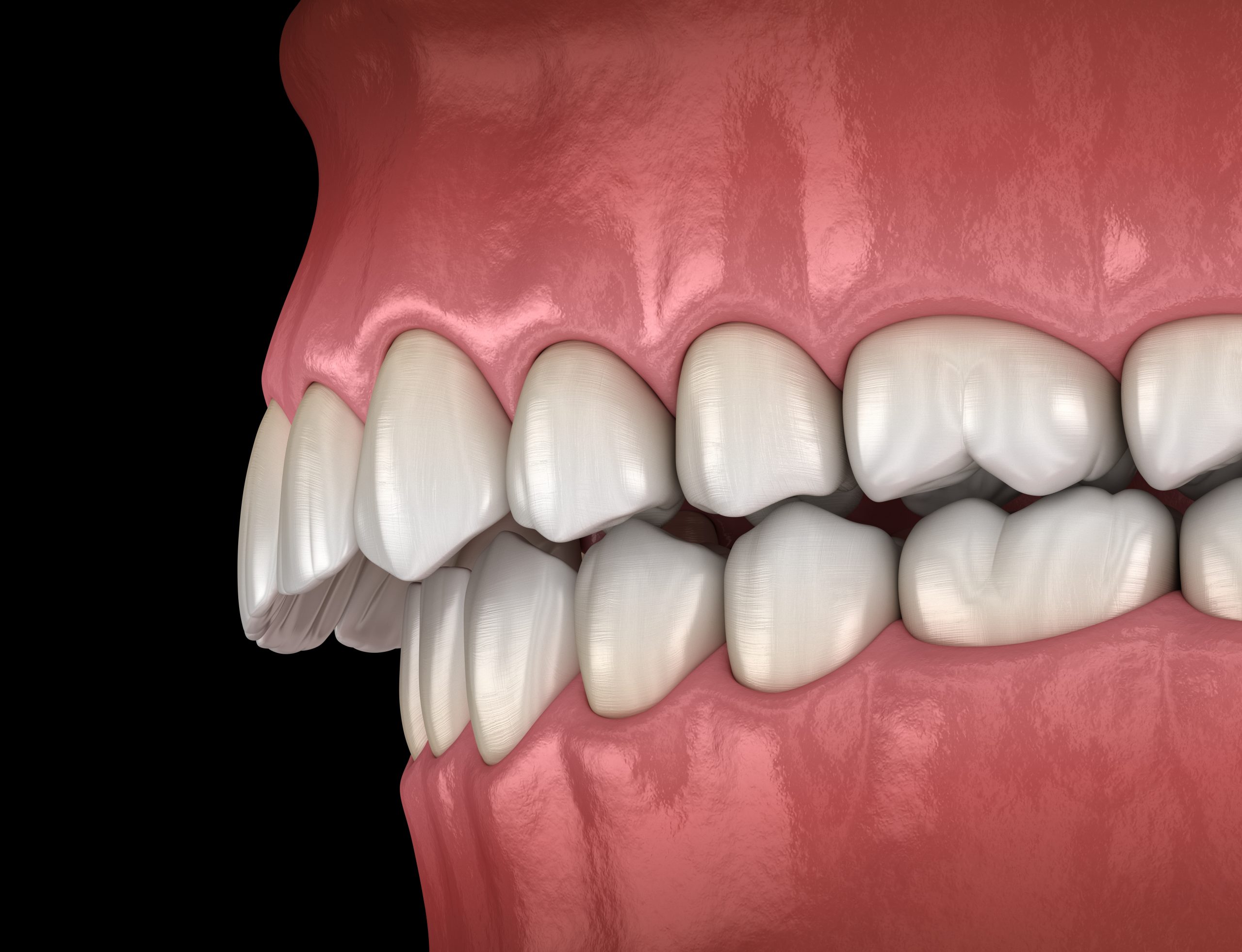 rendering of extreme overbite