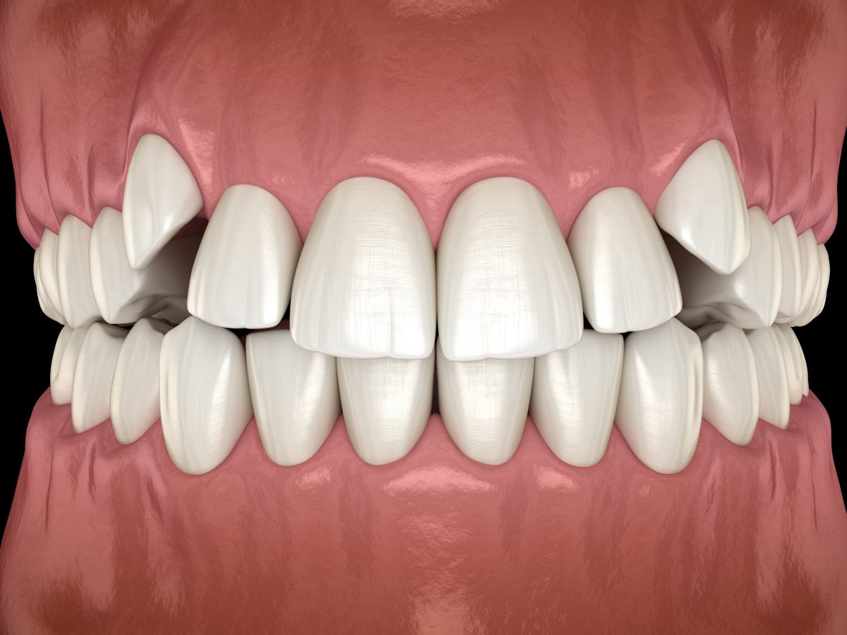 rendering of tooth overcrowding