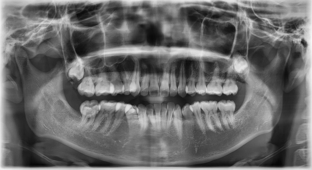 dental xray of the first signs of wisdom teeth coming in
