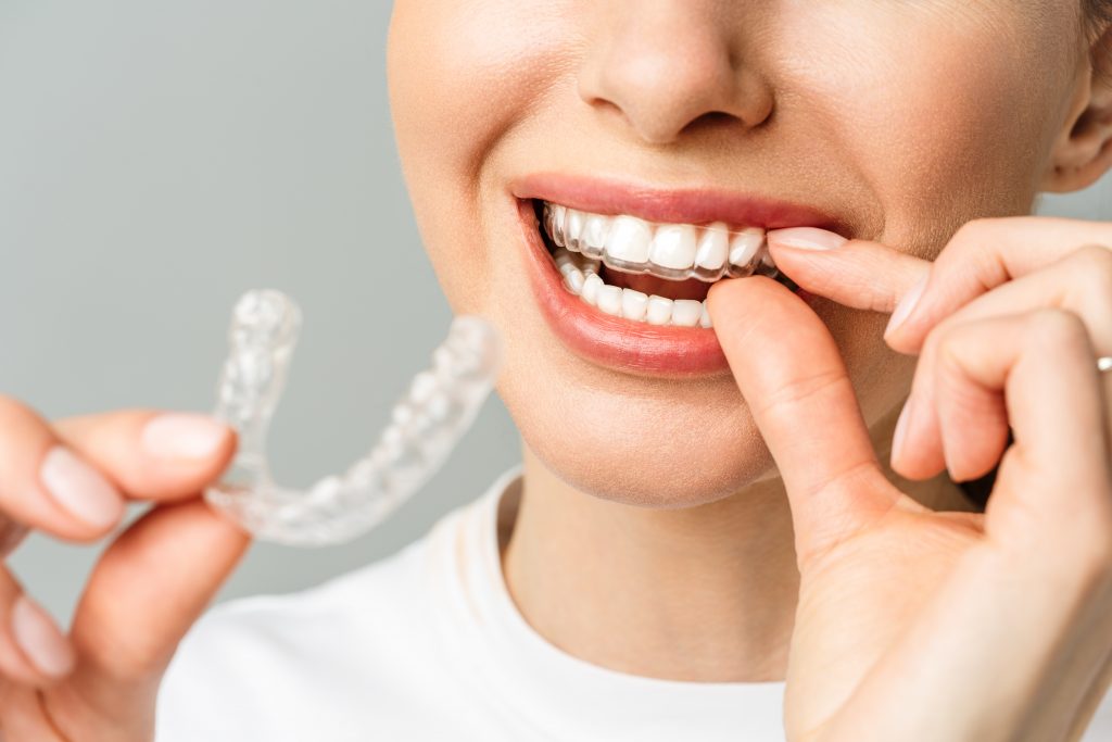 using invisible braces for oral health