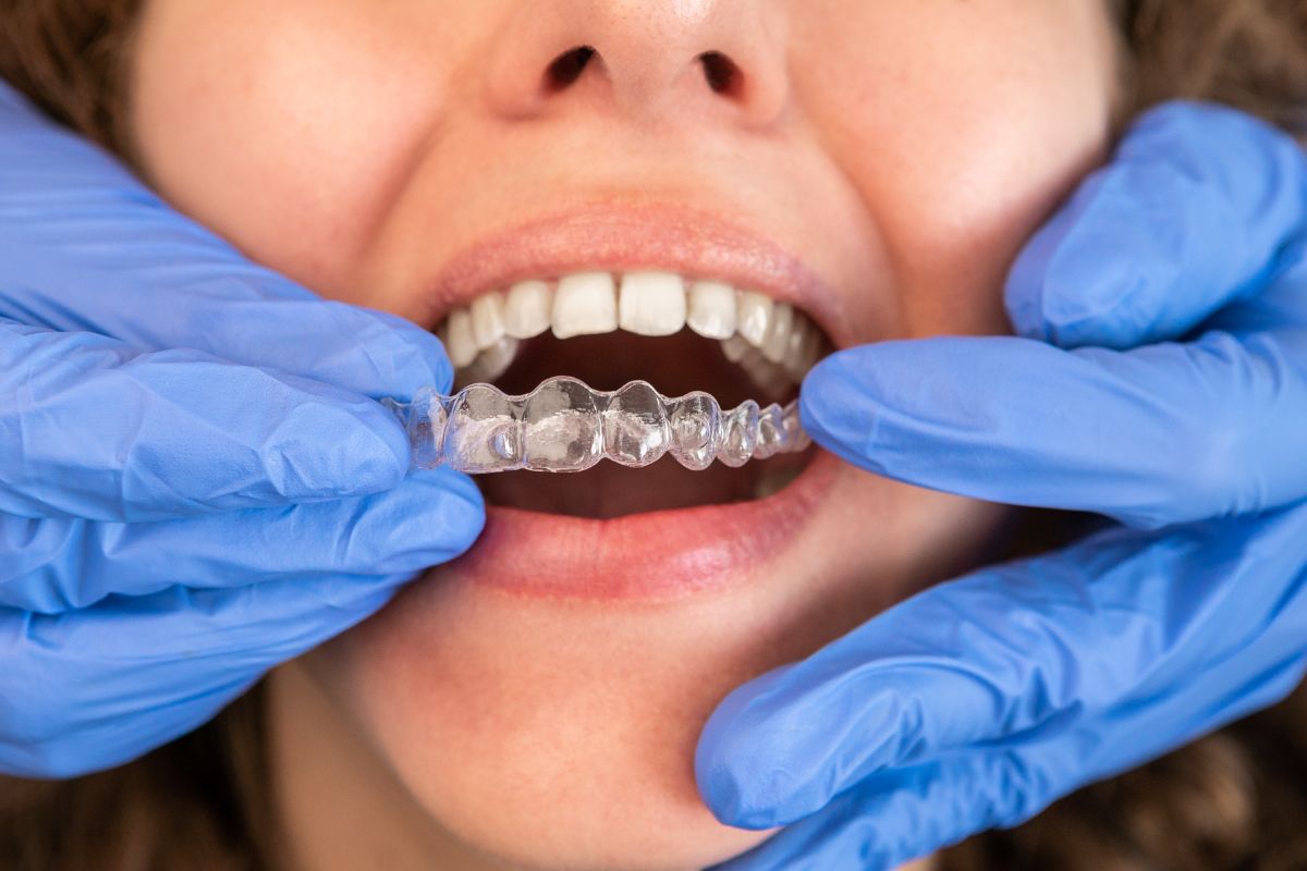 The Benefits of Teeth Alignment