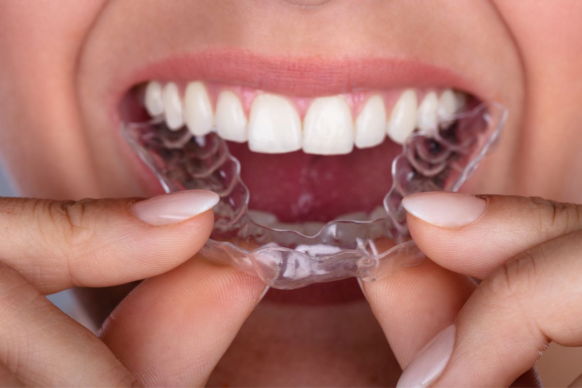 The Endurance Test How Long Does Teeth Alignment Last