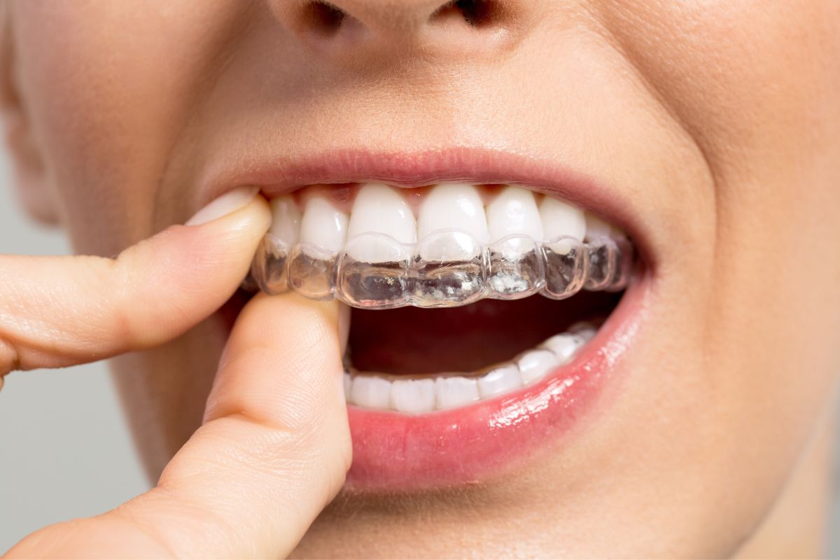 Maintenance-and-cleaning-tips-for-clear-removable-braces