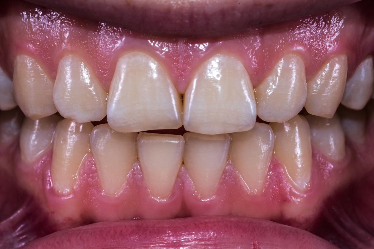 What is the Normal Position of Teeth when Mouth is Closed