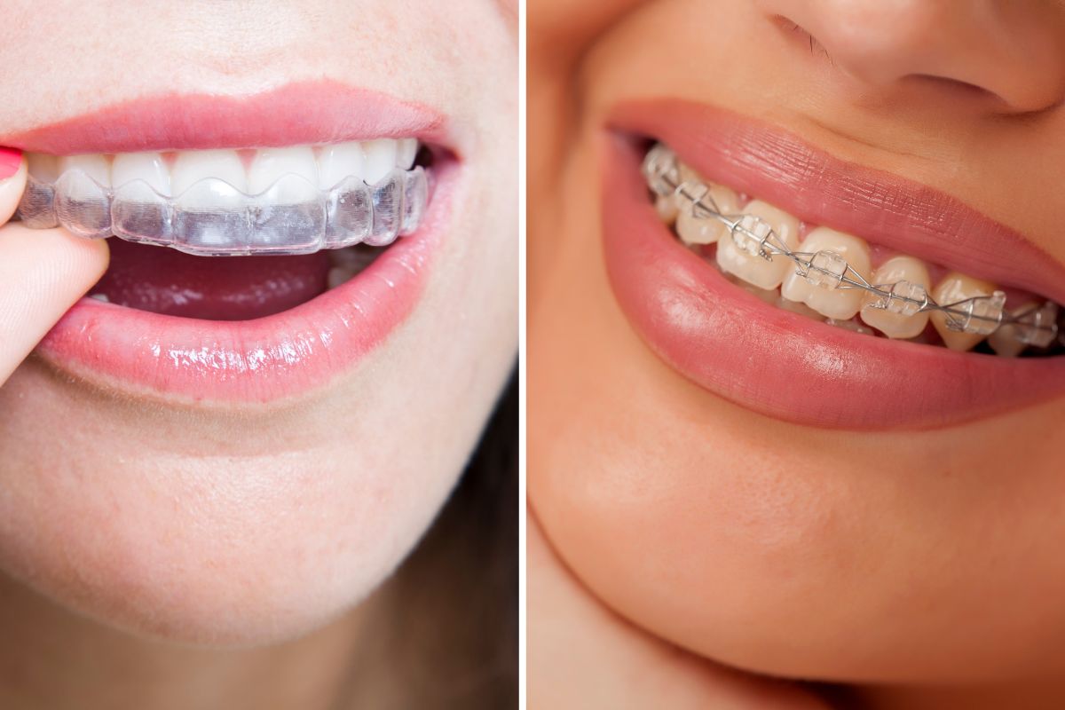 clear braces vs traditional braces
