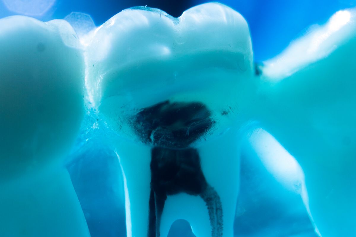 managing tooth decay and cavities (2)
